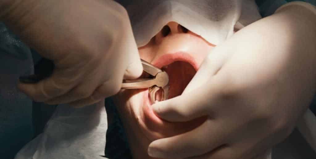 Dentysta używa narzędzi podczas usuwania zęba