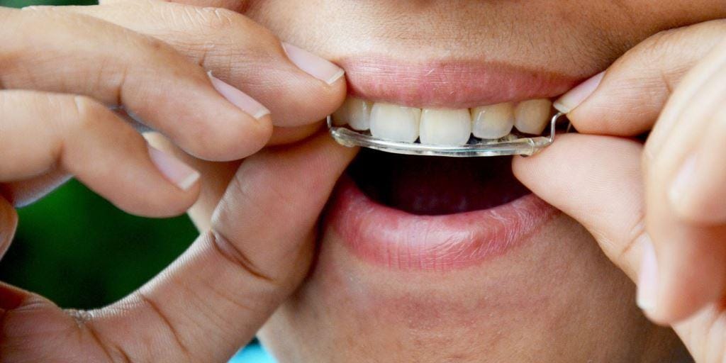 Osoba zakładająca ruchomy retainer na górne zęby