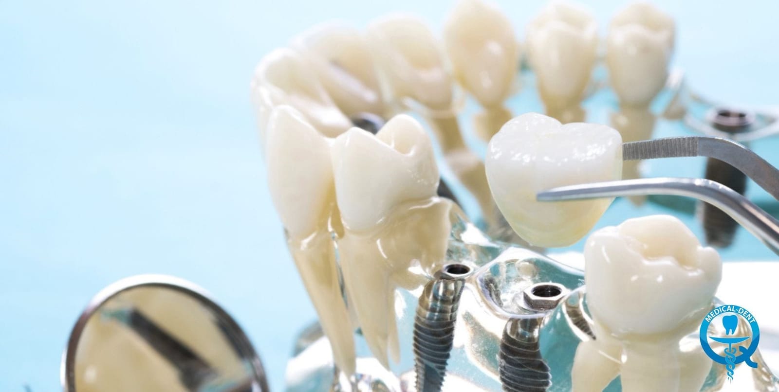 Model z implantami i uniesionym nad nimi uzupełnieniem zęba