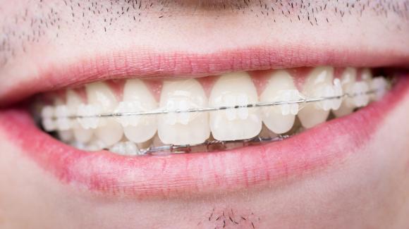 aparat-ortodontyczny-krysztaloy-szafirowy-medical-dent-uk