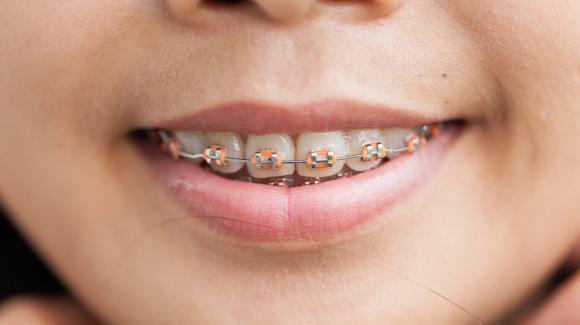 aparat dentar-ortodonție-metal