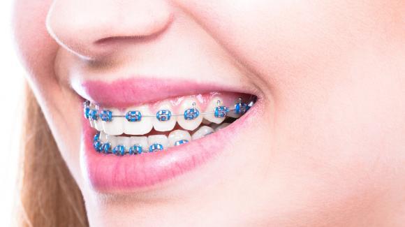 braces-orthodontic-metal