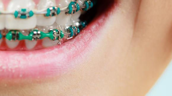 aparat dentar-ortodontic-metal-color
