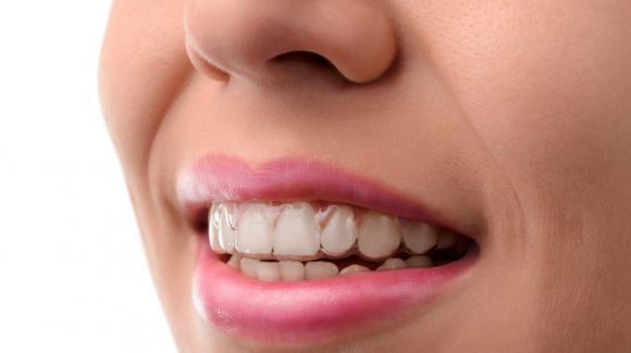 aparat dentar-ortodontic-mobil-Essix-retainer.