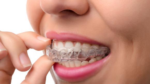 aparat dentar-ortodontic-mobil-Essix-retainer.