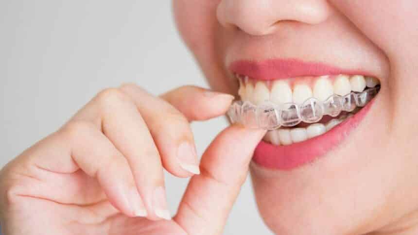 Overlay teeth whitening at home