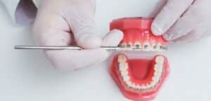 Obraz przedstawia zbliżenie na ręce dentysty pracującego nad modelowym uzębieniem. Widoczne są metalowe narzędzia dentystyczne oraz czerwony model uzębienia z zamocowanymi metalowymi aparatami ortodontycznymi. Zdjęcie wykonane z bliska, skupiając się na elemencie pracy dentystycznej.