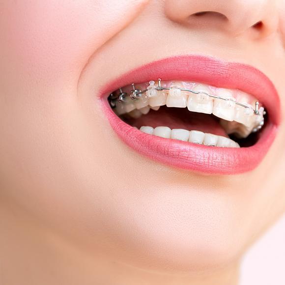 Ortodontická liečba - často kladené otázky