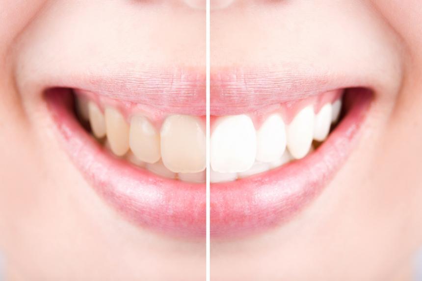 whitening-teeth-must-know