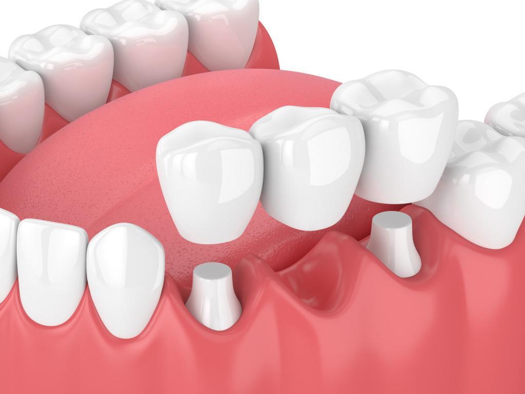 dental bridges