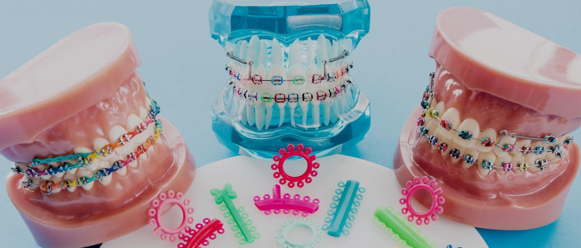 Types of braces in the UK which to choose?