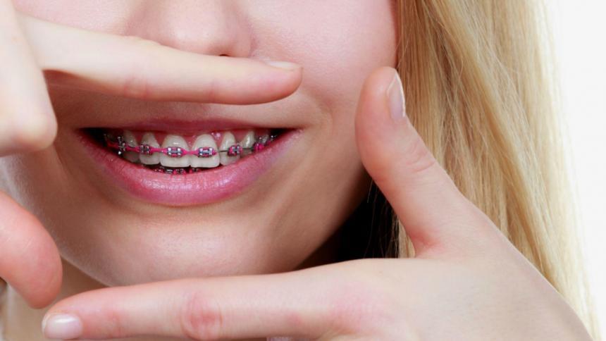 Types of braces in the UK - which to choose?