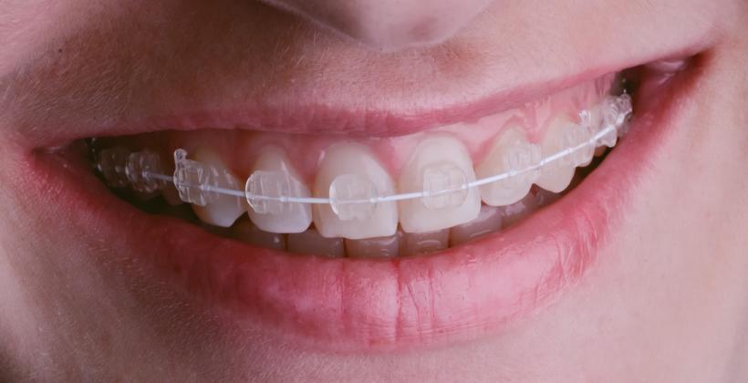 ceramic braces in the UK