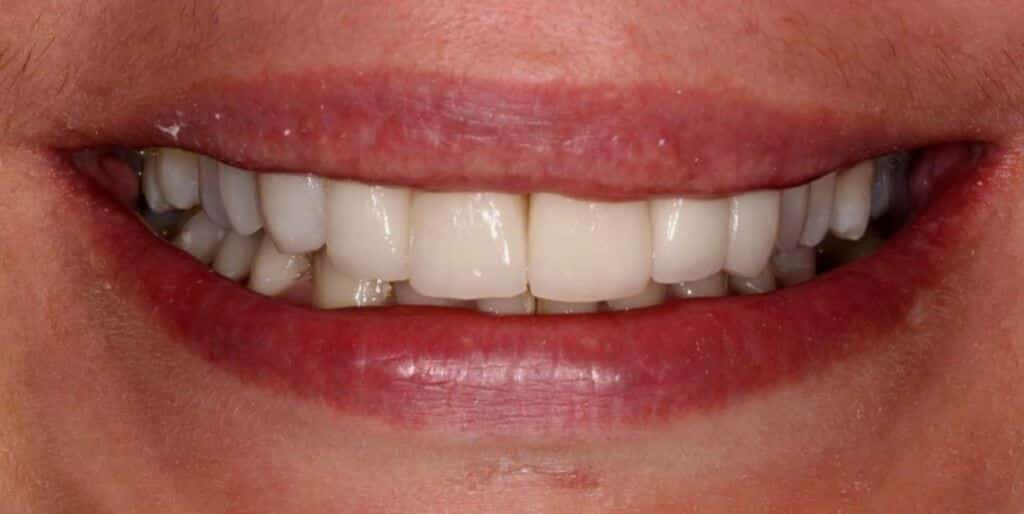 Veneers in the UK