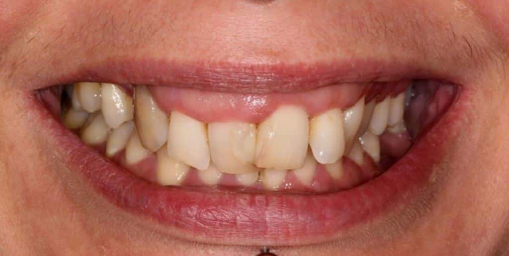 Veneers in the UK