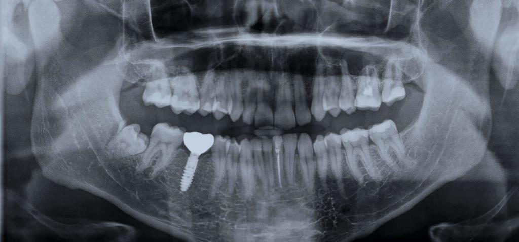 implant zęba w UK