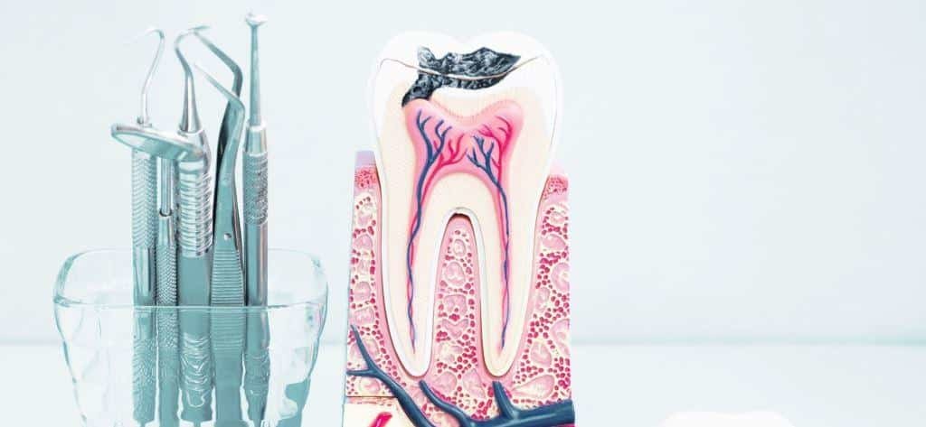 zubný kaz je najčastejšou príčinou zápalu zubnej drene 
