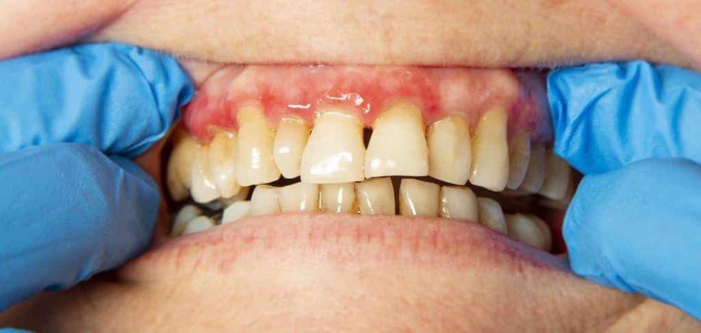 parodontitída