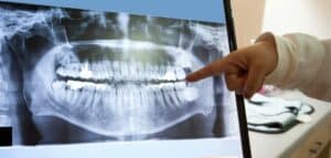 The image shows an X-ray of the patient's teeth displayed on a computer screen. You can see the dentist's hand pointing to a particular area on the jaw X-ray. The identity of the person cannot be identified from the image.