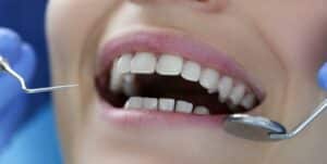 Fotografia prezintă un prim plan al gurii deschise a unei persoane în timpul unei vizite la dentist. Sunt vizibili dinții albi, sănătoși și instrumentele dentare din interiorul gurii. Imaginea prezintă o porțiune a feței fără a include elemente de identificare.