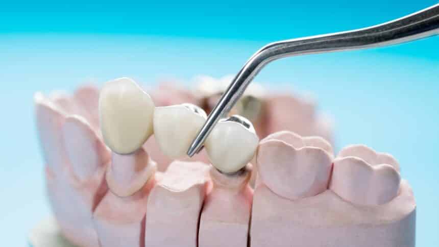 Zubné mostíky v Spojenom kráľovstve - všetko, čo potrebujete vedieť