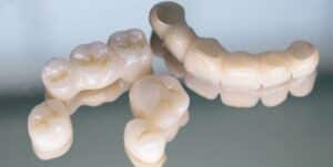 Imaginea prezintă trei dinți artificiali/denturi realizate dintr-un material asemănător porțelanului sau ceramicii. Sunt vizibile detalii precum coroanele dinților, spațiile libere pentru dinții lipsă și forma gingiilor. Fundalul este încețoșat și în nuanțe de gri.