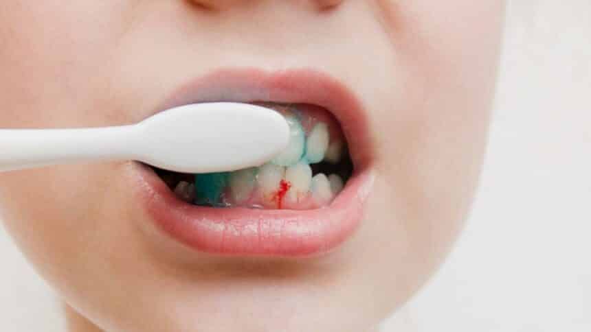 Bleeding gums - causes and treatment