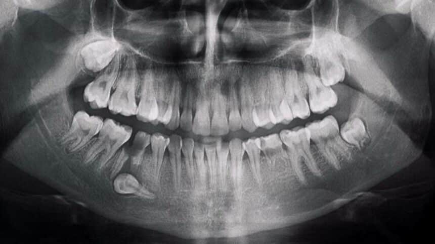 A retained tooth - what exactly is it and does it always need to be removed?