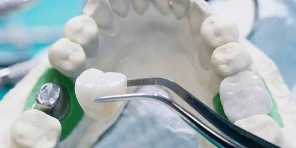 Missing tooth - when do you need to fill the gap left by an extracted tooth?