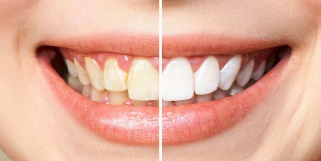 Teeth whitening with the Enlighten system