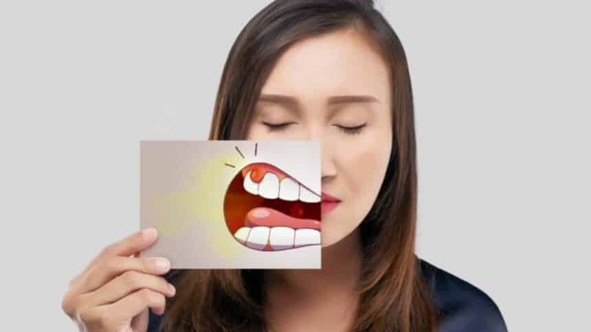 Gingivitis - symptoms and treatment