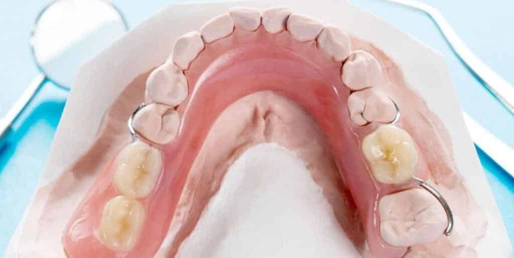 akrylové zubné náhrady v Spojenom kráľovstve