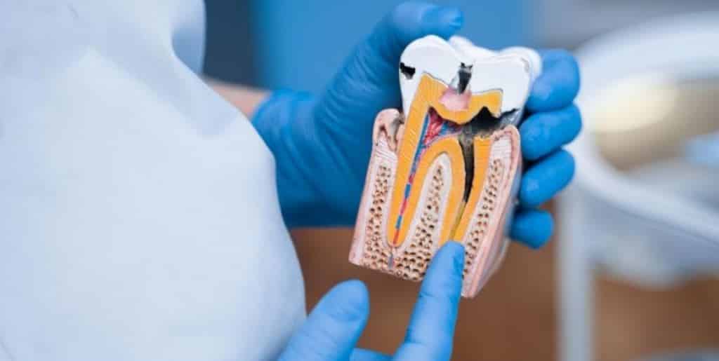 What are the causes of caries in children?