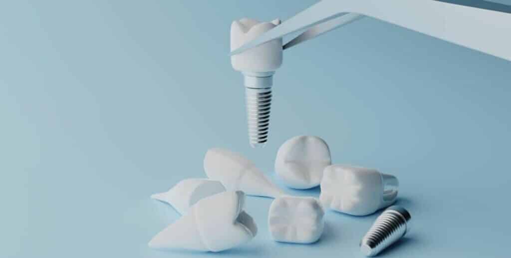 Zubné implantáty v Spojenom kráľovstve