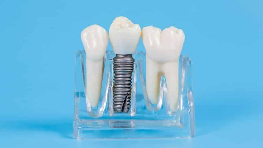 Dental implants in the UK - types and price