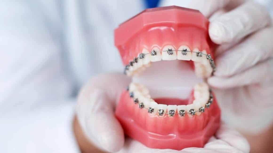 Polish orthodontist in the UK advantages, disadvantages and cost of