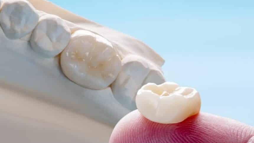 Porcelain crowns in the UK - everything you need to know