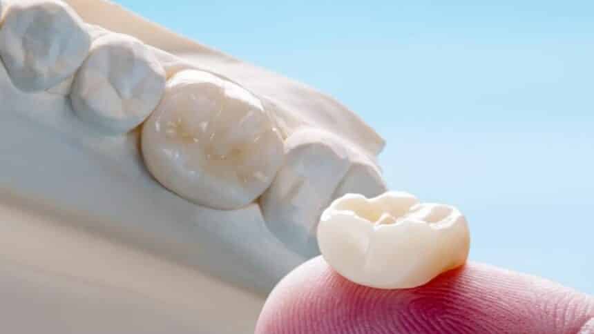 Porcelain crowns in the UK - everything you need to know Porcelain crowns in the UK - everything you need to know