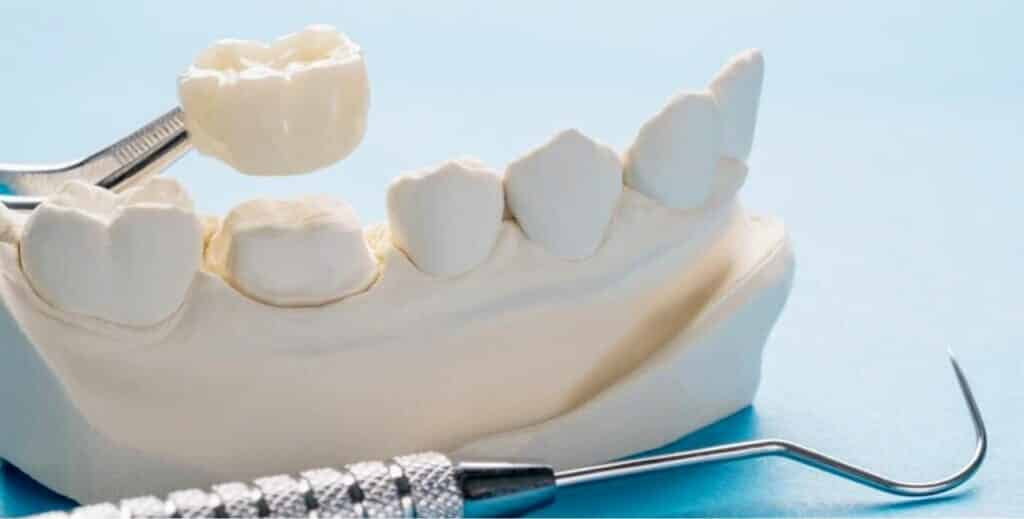 How do we divide porcelain crowns in the UK?