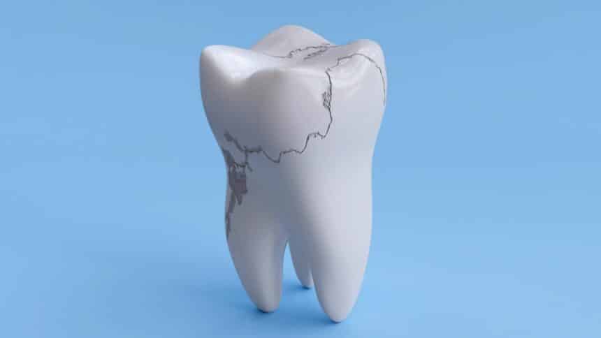 Pęknięty ząb – objawy i leczenie