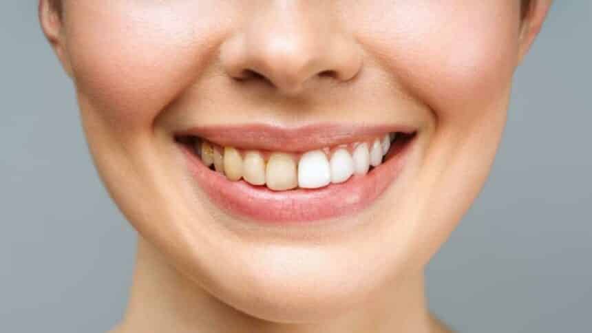 Przebarwienia na zębach – skąd się biorą, jak im zapobiegać i jak usunąć