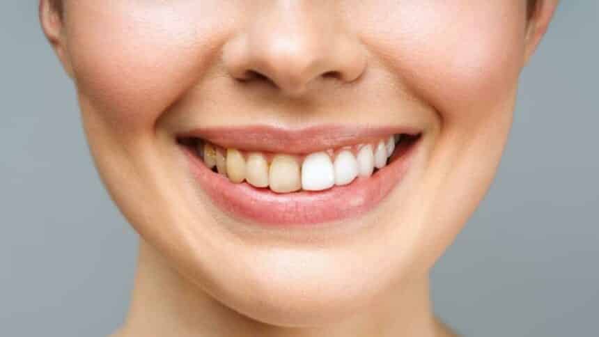 Discolouration on teeth - where it comes from, how to prevent it and how to remove it Discolouration on teeth - where it comes from, how to prevent it and how to remove it