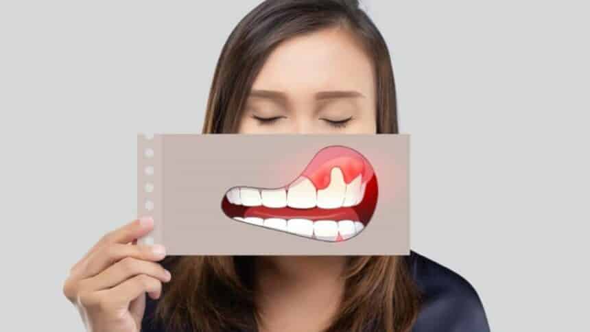 Gum disease - causes, symptoms and treatment