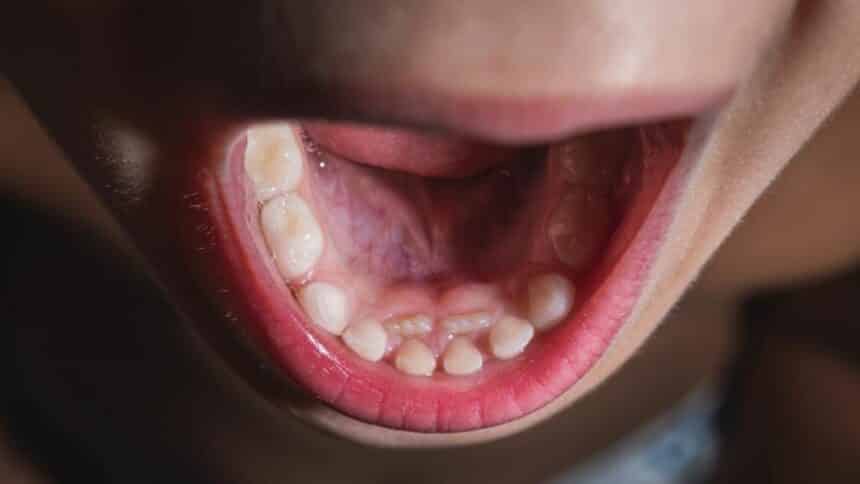 Frenectomy in the UK - indications and course of the procedure