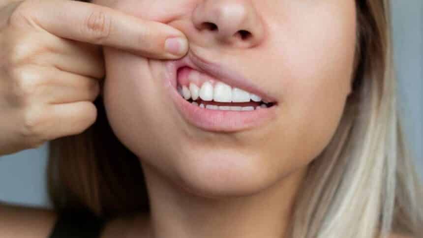 Pus in the gums - where it comes from and how to get rid of it