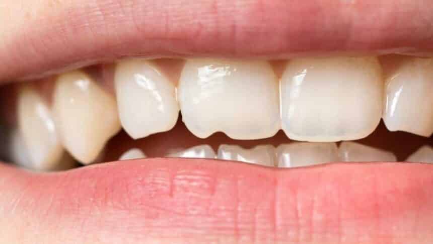 Chipped tooth - what to do and can it be prevented?