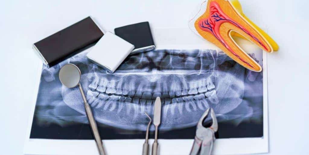 Tooth extractions in the UK