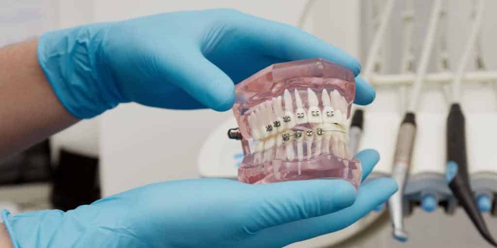 malocclusion in adults best corrected with braces