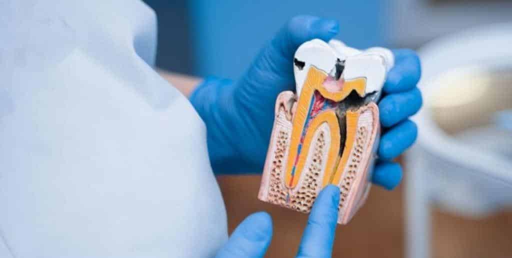 dental canals
