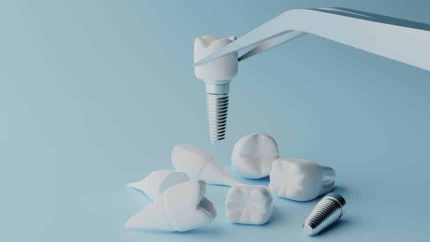 Od czego zależy cena implantu zęba w UK i ile kosztuje implant zęba w UK?